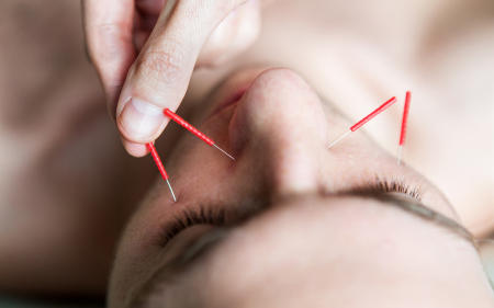 Starpoint Acupuncture